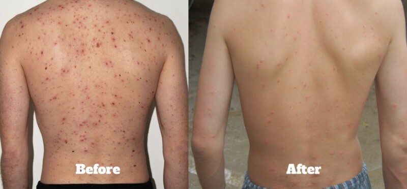 Male Body Acne Facial